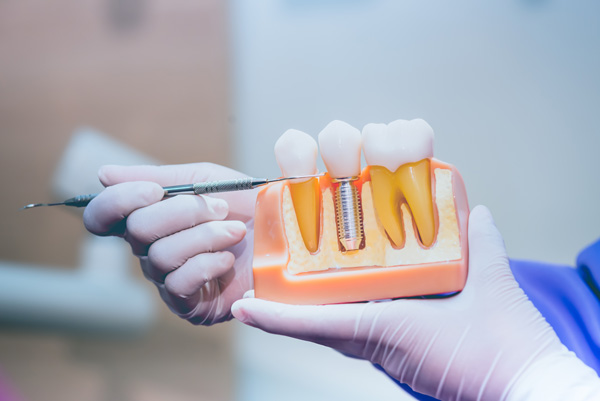 Dentist showing dental implant to patient at Riverwind Dental in Richmond, VA