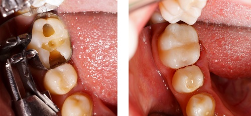 Tooth Colored Filling Before After