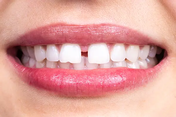 chipped tooth 5