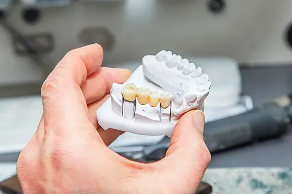Hand holding a dental model with a fixed dental bridge at Riverwind Dental in Henrico, VA
