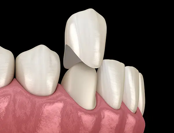 A dental crown being placed on a front tooth at Riverwind Dental in Henrico, VA