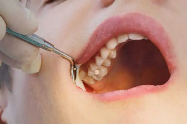 A dentist examining a patient’s tooth cavity with a dental instrument before placing a filling at Riverwind Dental in Henrico, VA