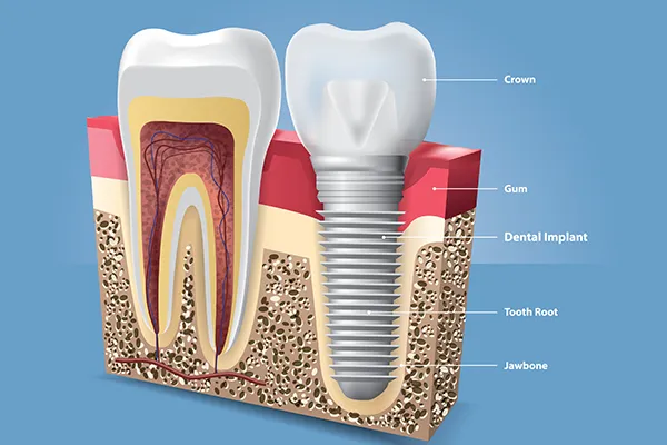 A labeled cross-section of a dental implant, showing the crown, abutment, post, and integration into the jawbone illustrated by Riverwind Dental in Henrico, VA