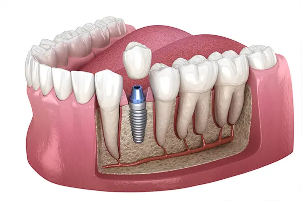 dental implant 9