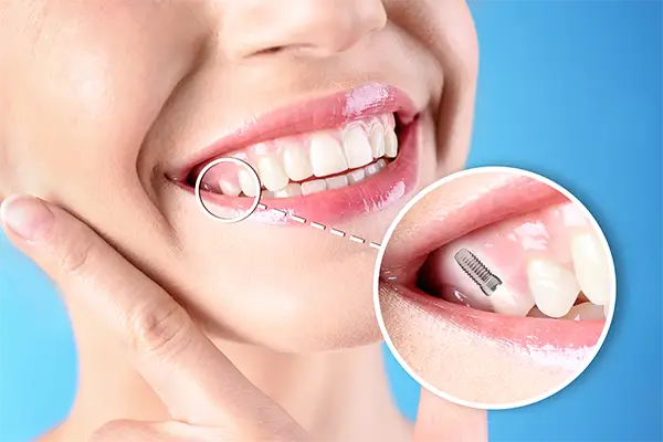 Smiling woman pointing to her teeth with an inset showing an x-ray view of a dental implant set in the jaw at Riverwind Dental in Henrico, VA