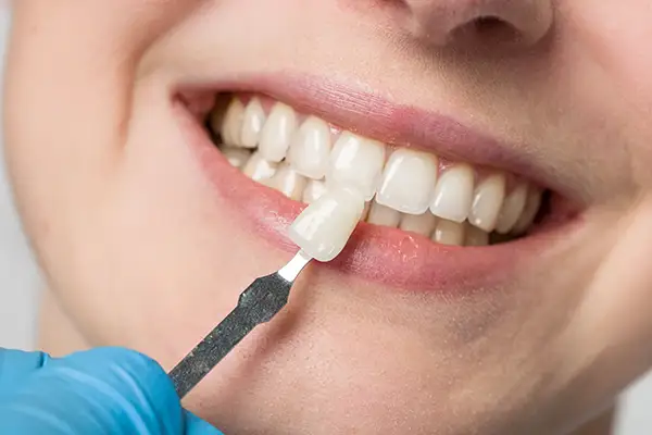 Dentist using a precise shade matching tool to select the ideal lumineer for a smiling patient's teeth at Riverwind Dental in Henrico, VA