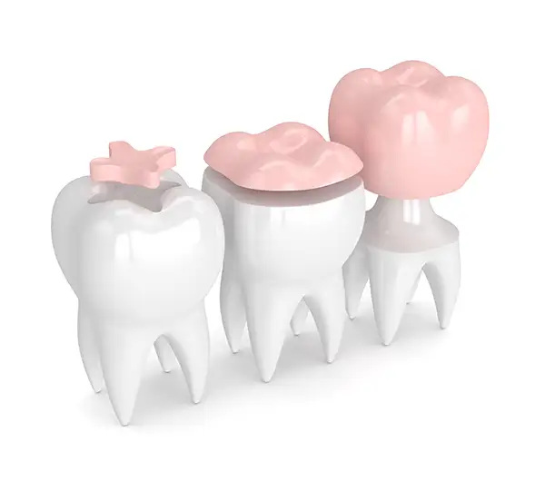 Three teeth, one each with inlays, onlays, and crowns, highlighting different restorative dentistry options at Riverwind Dental in Henrico, VA