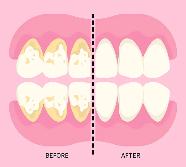 Before and after results of a professional teeth cleaning at Riverwind Dental in Henrico, VA