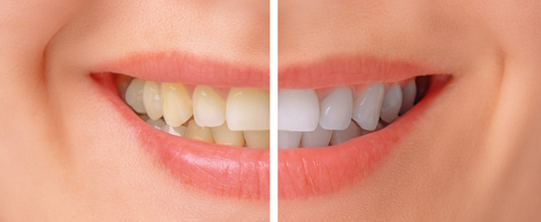 side by side teeth whitening