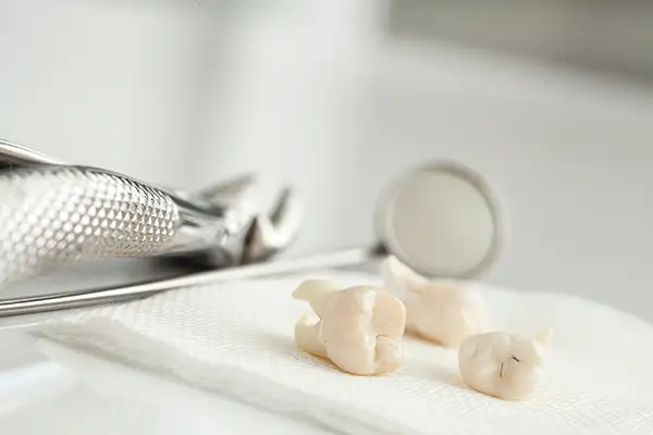 Close-up of three extracted wisdom teeth placed on a napkin with dental tools in the background at Riverwind Dental in Henrico, VA